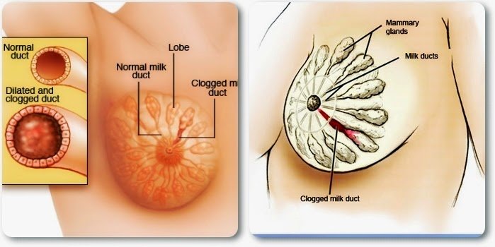 Mastitis: Gejala, Penyebab, dan Cara Mengatasinya